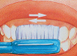 牙周病的預防與治療  