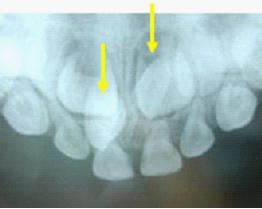 兒童牙醫-多生牙齒