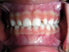 兒童牙醫-牙齒變黑
