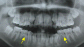兒童牙醫-先天性缺牙-缺兩顆牙