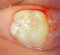 兒童牙醫-大臼齒